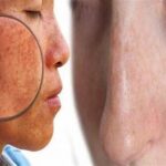 Langkah Mudah Menghilangkan Bintik Otomatis